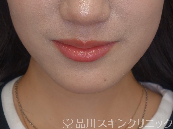 症例NO.74477のBEFORE写真
