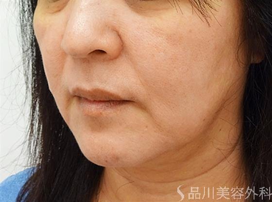 症例NO.36277のBEFORE写真