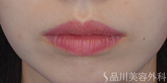 症例NO.72045のBEFORE写真