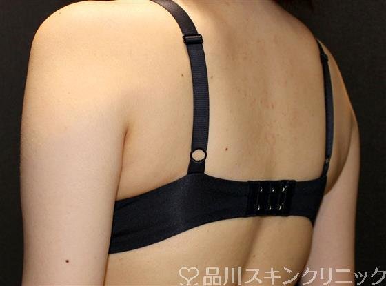 症例NO.61350のAFTER写真