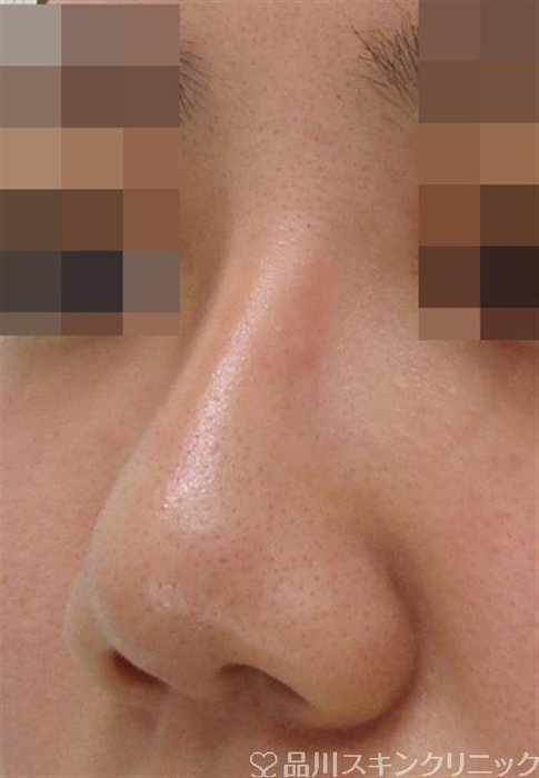 症例NO.38026のAFTER写真