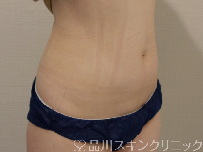 症例NO.74485のAFTER写真