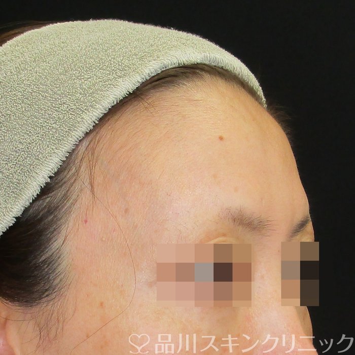 症例NO.74631のBEFORE写真