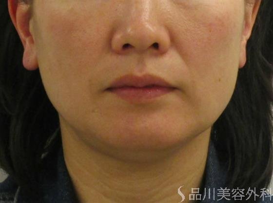 症例NO.48017のBEFORE写真
