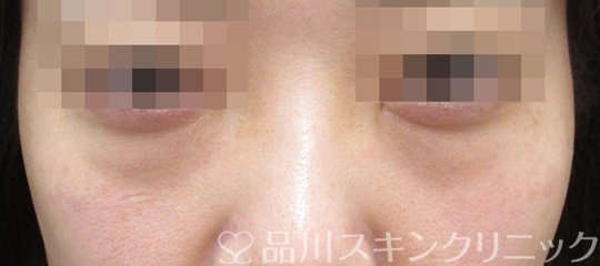 症例NO.64601のBEFORE写真