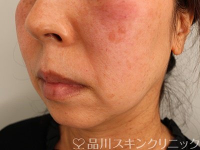 症例NO.75117のBEFORE写真