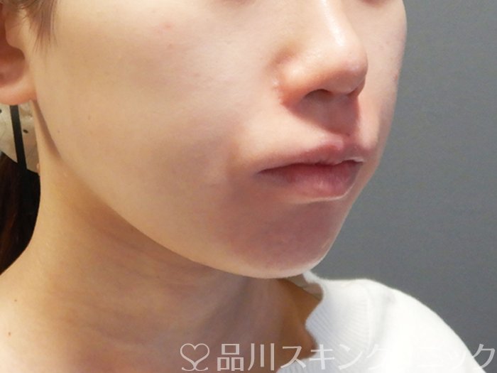 症例NO.73277のAFTER写真