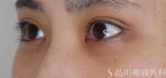 症例NO.52482のAFTER写真