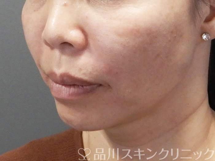 症例NO.73479のAFTER写真