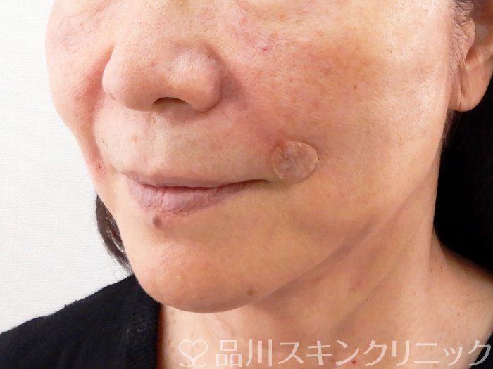 症例NO.62544のAFTER写真