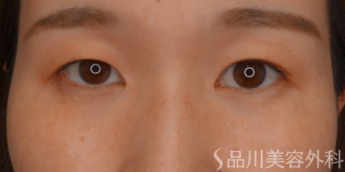 症例NO.74543のAFTER写真