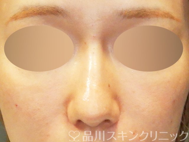 症例NO.67901のAFTER写真