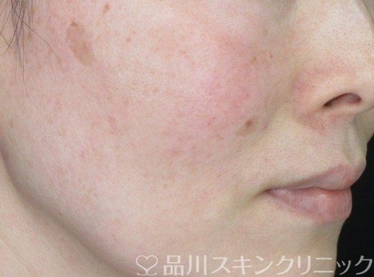 症例NO.69786のBEFORE写真
