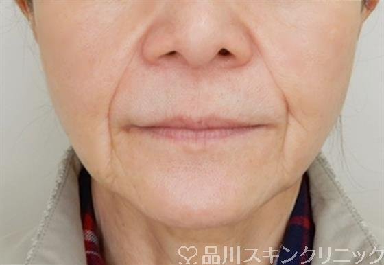 症例NO.58570のBEFORE写真