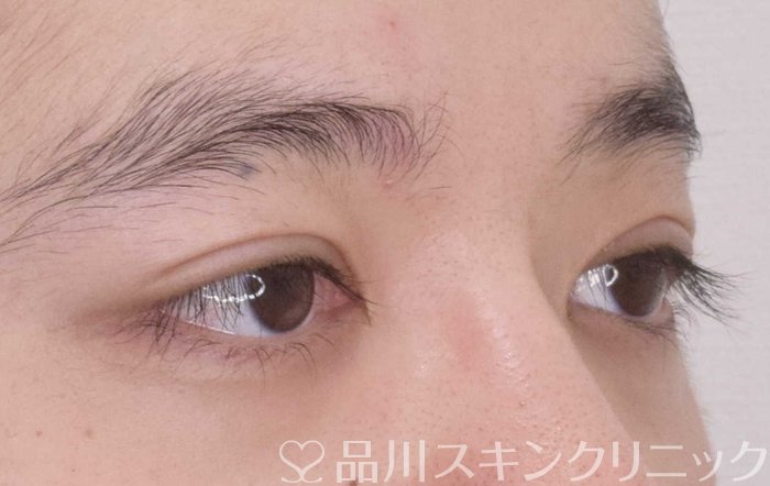 症例NO.64807のAFTER写真