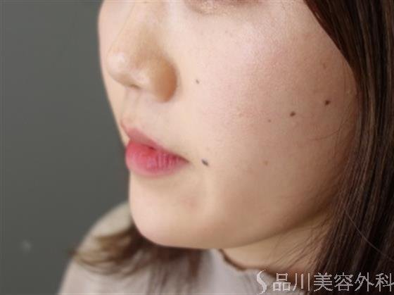 症例NO.49712のAFTER写真