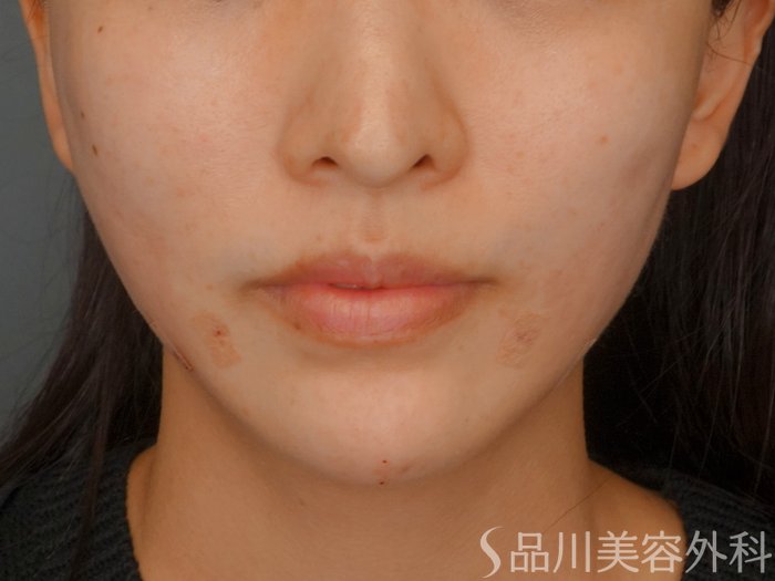 症例NO.73712のAFTER写真