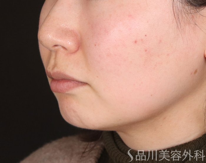 症例NO.73272のBEFORE写真