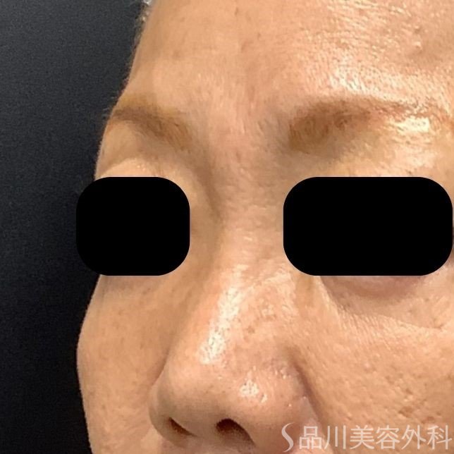 症例NO.75311のBEFORE写真
