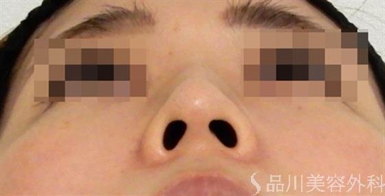 症例NO.37982のAFTER写真