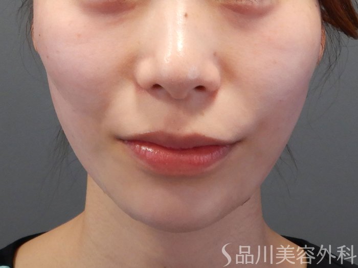 症例NO.72961のAFTER写真