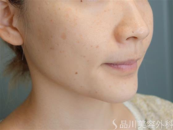 症例NO.52146のBEFORE写真