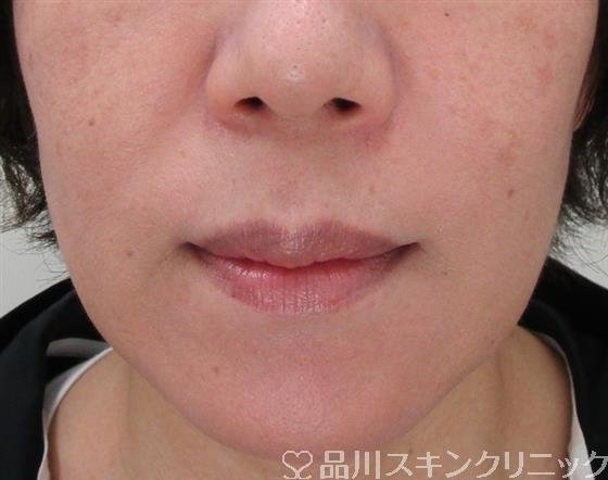 症例NO.31411のAFTER写真