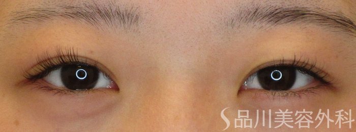 症例NO.65400のBEFORE写真