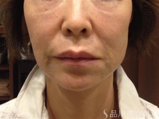 症例NO.24564のBEFORE写真