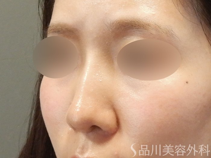 症例NO.65690のAFTER写真