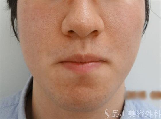 症例NO.22260のBEFORE写真