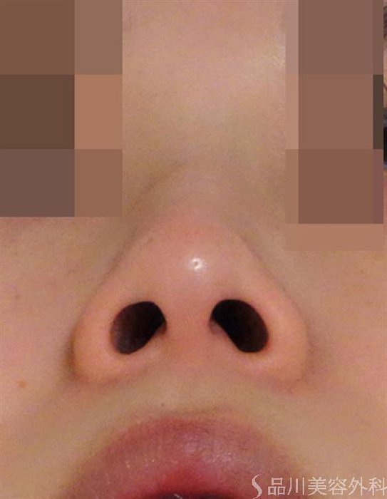症例NO.44042のBEFORE写真