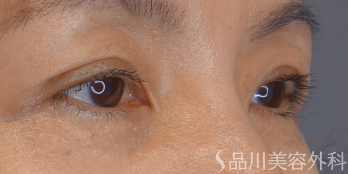 症例NO.72495のAFTER写真