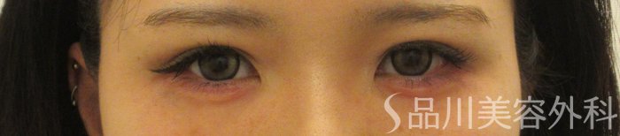 症例NO.73390のAFTER写真