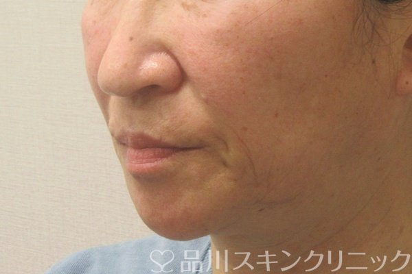 症例NO.75165のBEFORE写真