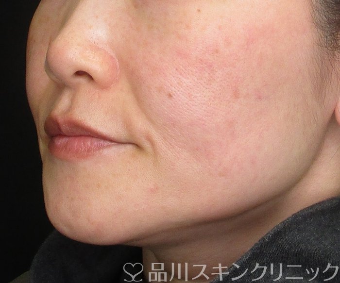 症例NO.75071のBEFORE写真