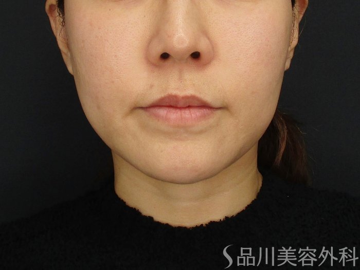 症例NO.69641のBEFORE写真