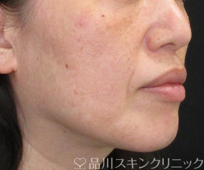 症例NO.74806のBEFORE写真