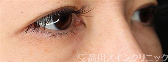 症例NO.56057のBEFORE写真
