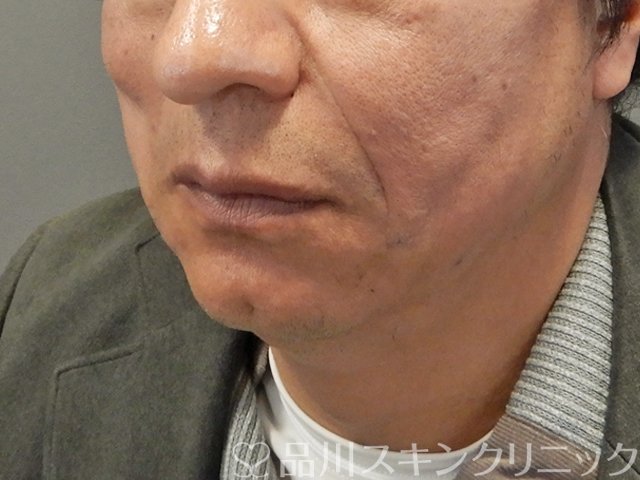 症例NO.75134のAFTER写真