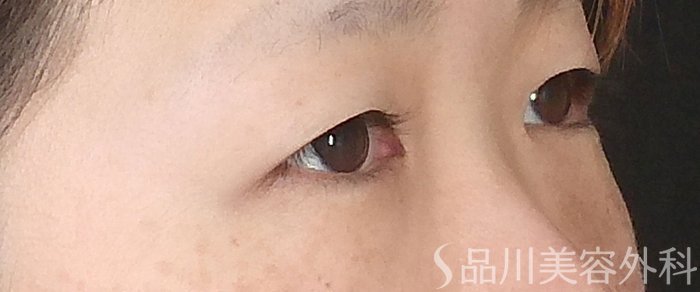 症例NO.69401のBEFORE写真