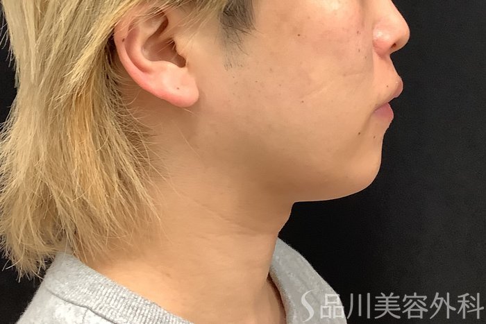 症例NO.75333のBEFORE写真