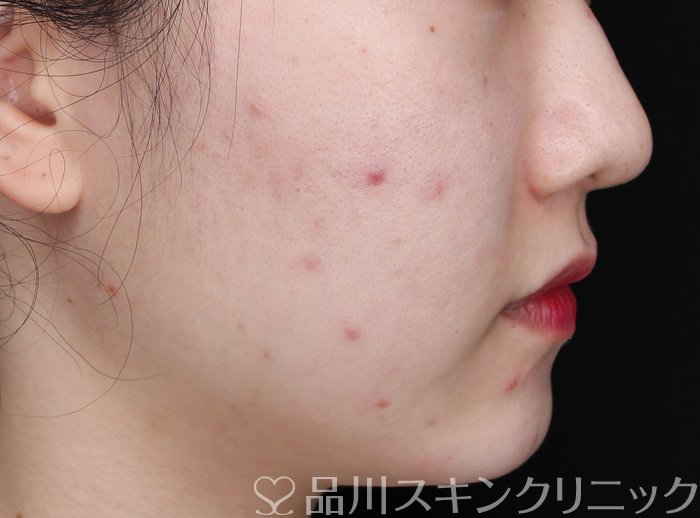 症例NO.71067のBEFORE写真
