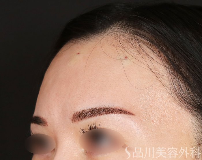 症例NO.73682のAFTER写真