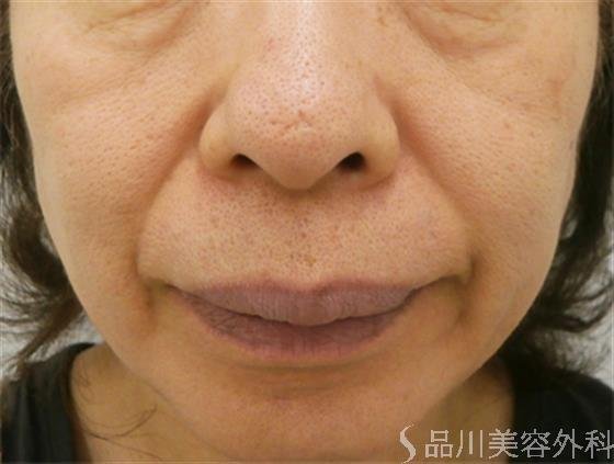 症例NO.20789のAFTER写真