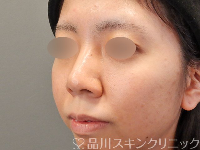 症例NO.75198のBEFORE写真