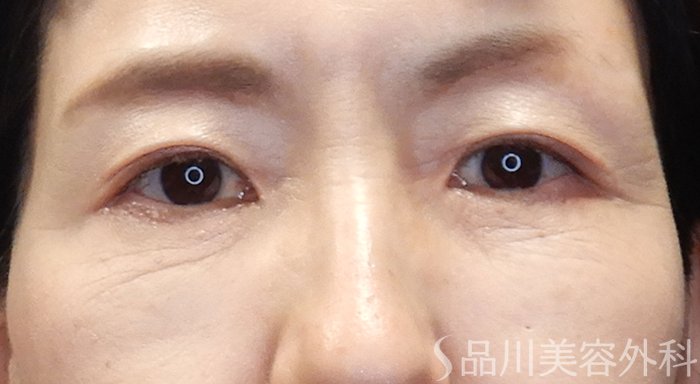 症例NO.70529のAFTER写真
