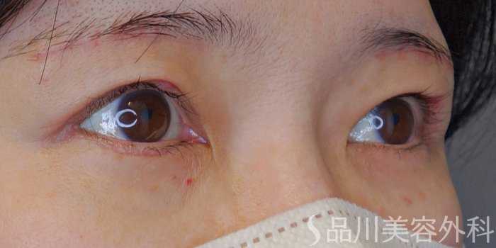 症例NO.70139のBEFORE写真