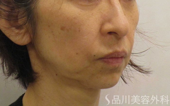 症例NO.65529のBEFORE写真
