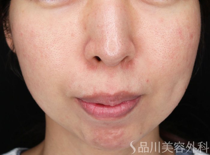 症例NO.69480のBEFORE写真